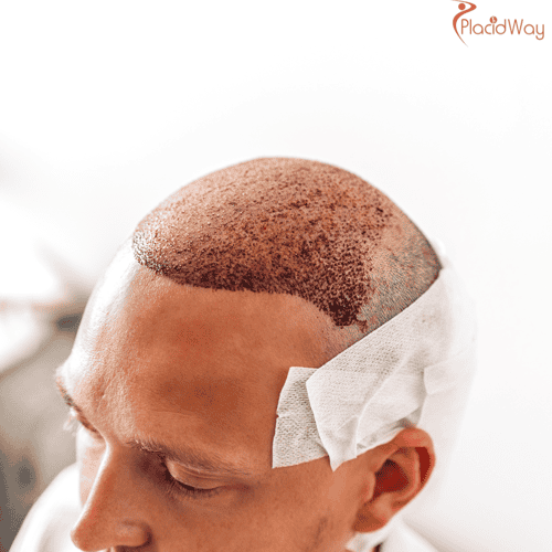 Why Should You Choose Hair Transplant in India?
